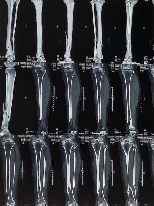 胫腓骨开放骨折外固定支架治疗一例