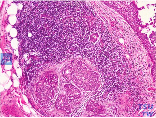 乳腺导管原位癌的鉴别诊断