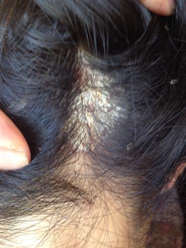 问:我头上长了一块像头皮藓一样的东西.请帮我看一下,是什么?