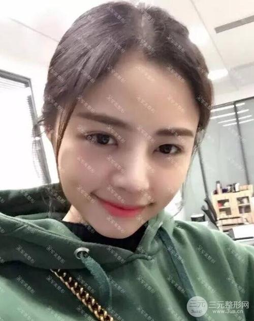 隆鼻整形真实案例附上前后对比图片分享前后恢复过程