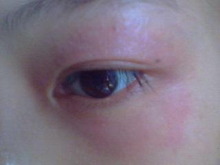 眼睛周围很红,怎么办.