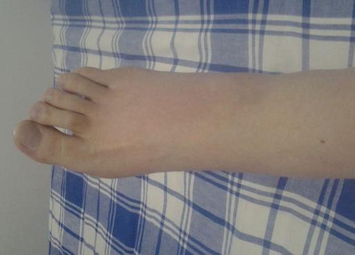 一,脚部水肿一般来说,人们很少会出现脚部水肿的现象,但是也有因为