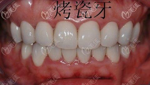 我30岁做了满口固定烤瓷牙戴了十年的烤瓷牙拆了突然好疼