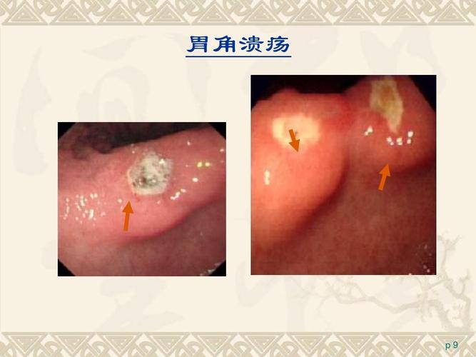 医药卫生 临床医学 消化性溃疡药物治疗的历史与进展ppt 胃角溃疡 p9