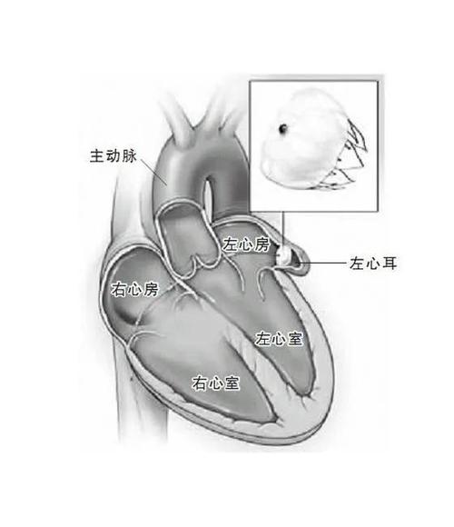 为了活命,这次必须"堵耳朵"——西安大兴医院成功实施左心耳封堵术