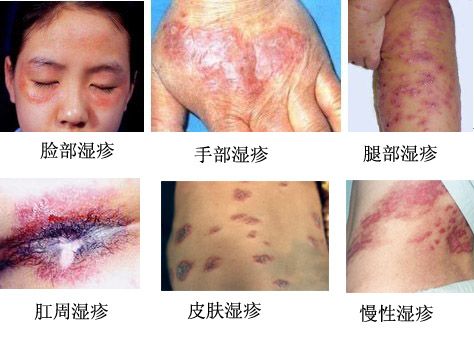 湿疹的症状图片及治疗