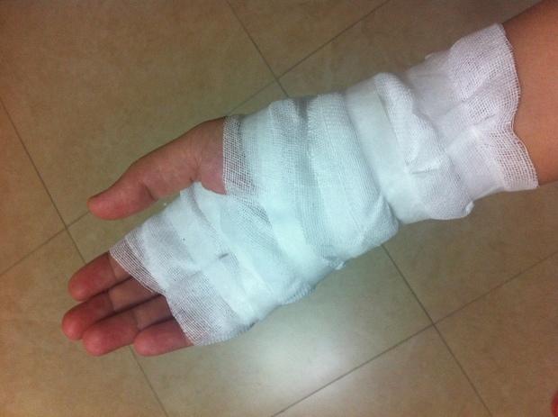 手烫伤了怎么办_手烫伤了怎么处理