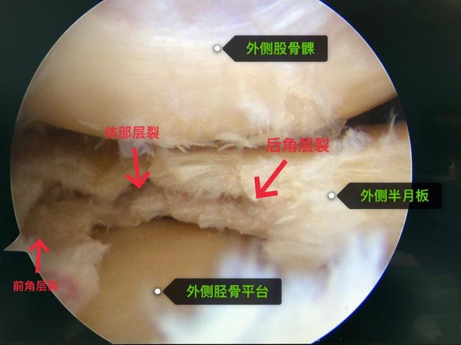 外侧半月板损伤缝合