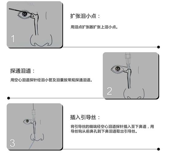 人工鼻泪管——告别溢泪,不让泪水模糊你的双眼