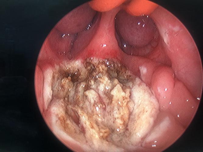 孩子腺样体,扁桃体肥大,切还是不切?假如要切除,全部?