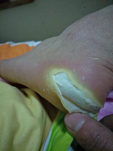 脚后跟这是怎么回事求助,,还有白色水