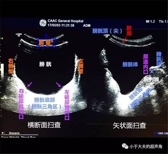 超声膀胱如你所了解的那样吗