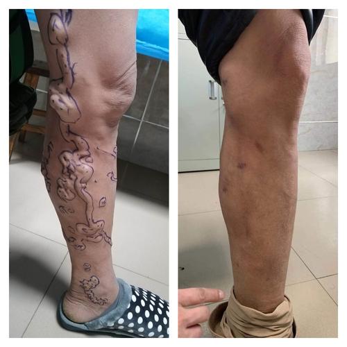 下肢静脉曲张专业健康宣教(值得收藏)