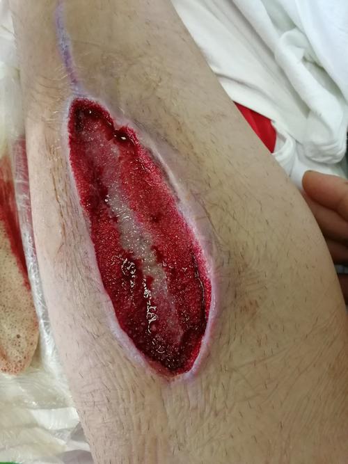 用新理念告别烂伤口