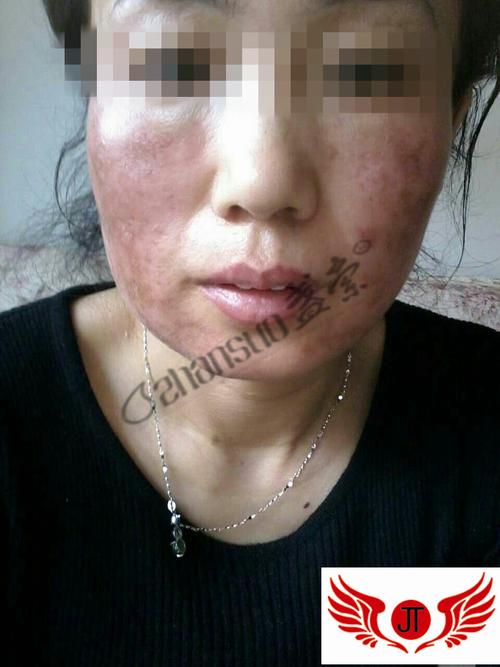 盏索解决严重铅汞中毒成功案例