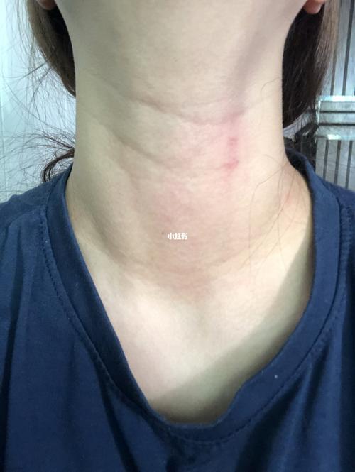 脖子凸起一块是甲状腺肿大吗_甲状腺_医疗健康_医疗