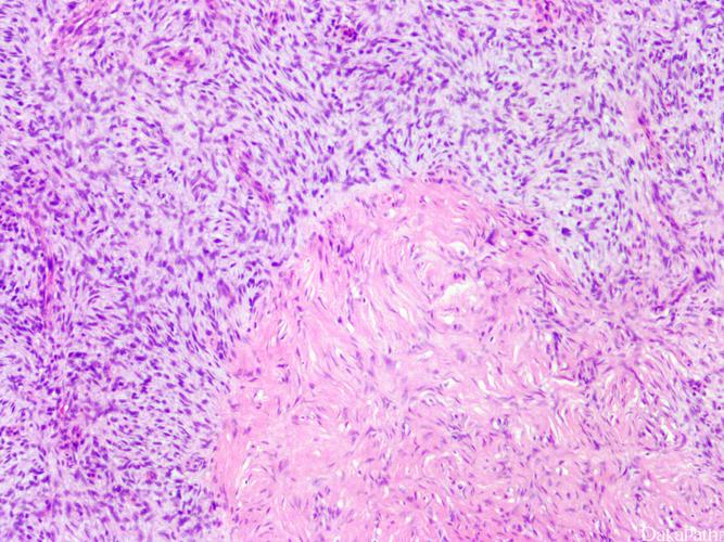 隆突性皮肤纤维肉瘤