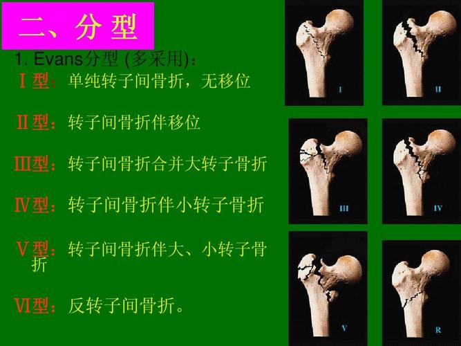 无忧文档 所有分类 医药卫生 临床医学 股骨粗隆间骨折ppt  二,分 型