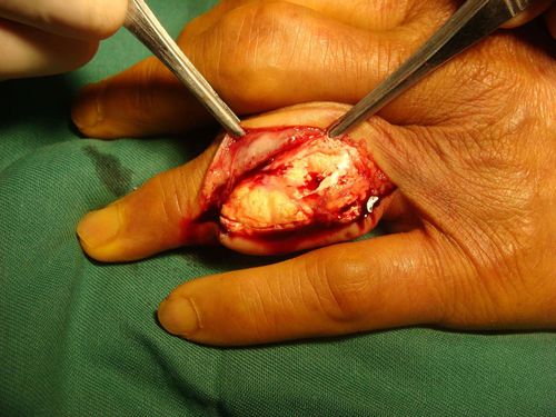 多么痛的领悟～痛风