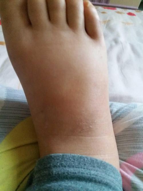 脚肿的像面包一样,加油,再坚持20天解放