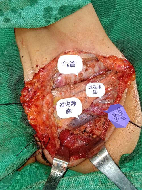 甲状腺外科手术,因为专注,所以专业——中医院外二科