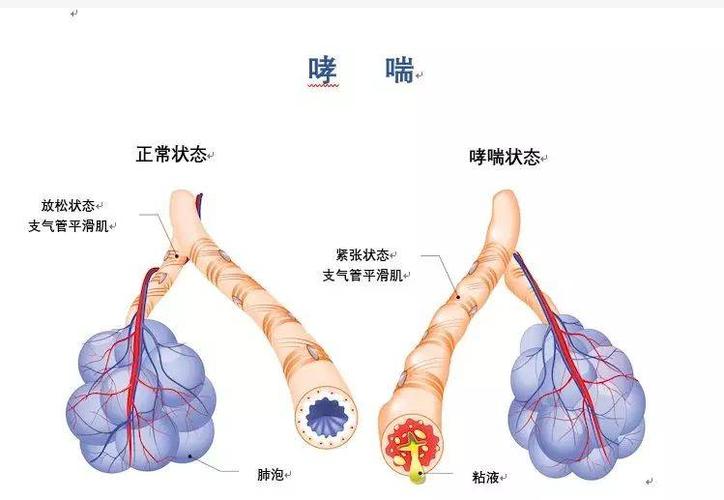 其它 全程管理 控制哮喘   典型症状为发作性伴有哮鸣音的呼气性呼吸