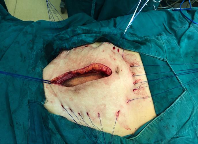 下腹壁切口疝无张力修补