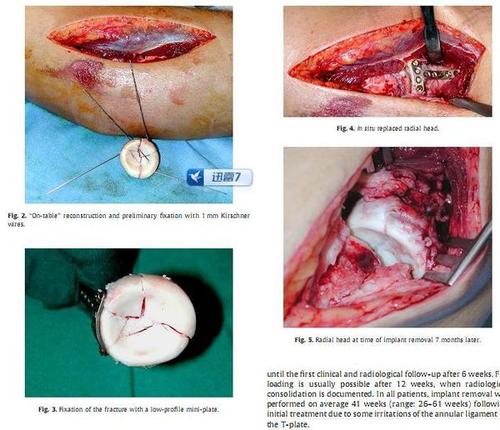 但对于严重粉碎的桡骨小头骨折,受手术切口空间限制往往难于重建,国外