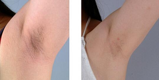激光脱腋毛价格是多少