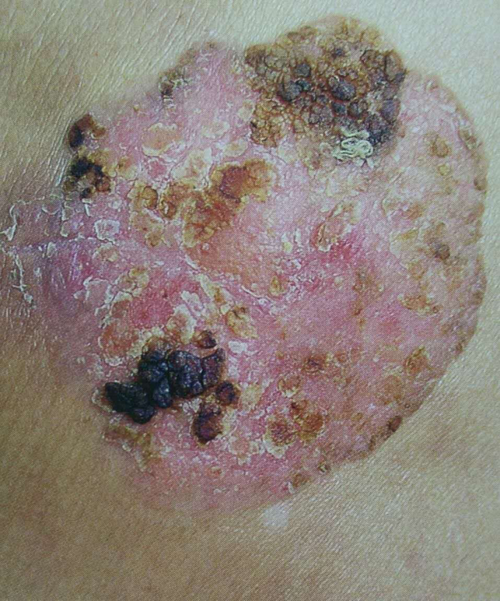 鲍温病 :是一种表皮内的鳞状细胞癌,又称"皮肤原位癌".