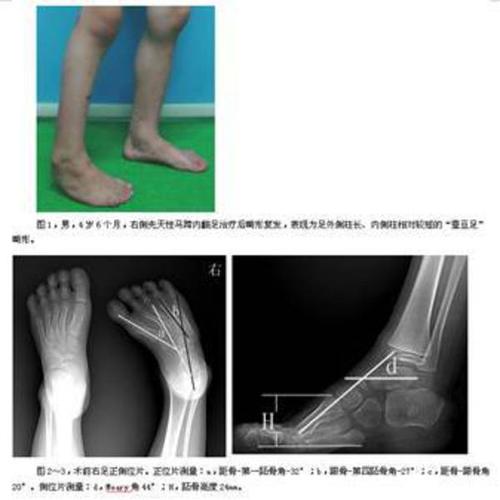   图1,男,4岁6个月,右侧先天性马蹄内翻足治疗后畸形复发,表现