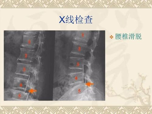 腰椎特性,结构分解,附上诊断方法及x光片检查