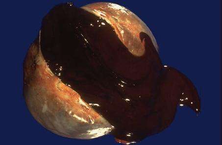 狐大医 | 巧克力囊肿是巧克力吃多了?