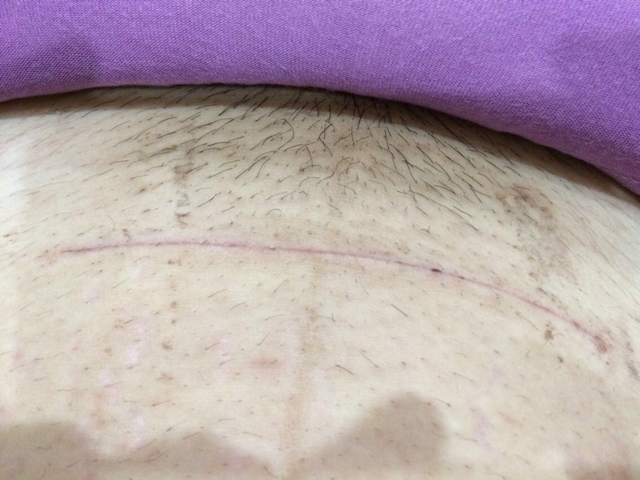 剖腹产12天伤口的样子