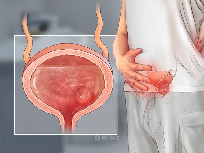 尿频,尿急,尿痛,当心是膀胱癌!身体出现这3大预警时,千万别忽视