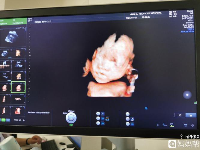 有没有跟我一样的宝妈,胎儿鼻骨及颌骨扁平