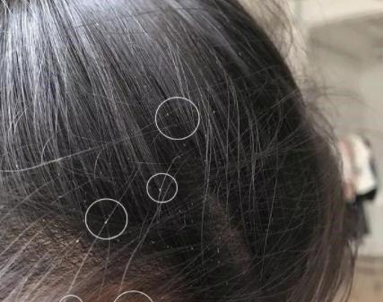为什么30年前男女老少都有虱子,现在却没有了?专家揭晓答案