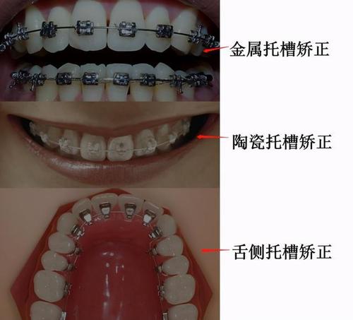 牙齿矫正的基本原理是什么?|正畸|手术|矫治器_网易
