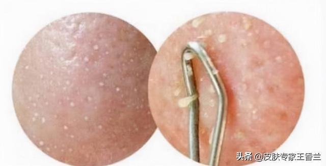 脸上挤出来白色条状物是什么东西有办法去除吗