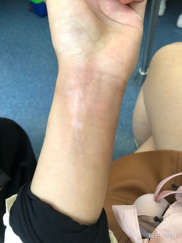烫伤烧伤时女生如何处理及后期如何不留疤痕