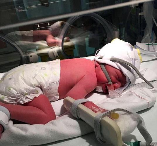 怀孕五个月,不幸的还是来临了,两个孩子,一个已因患罕见疾病病死于