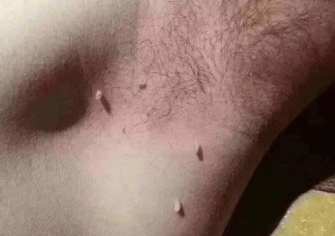 女子腋下长满"小肉条",因确诊感染hpv?医生:切忌别再