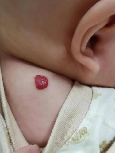 认识红胎记——婴幼儿血管瘤科普(一)