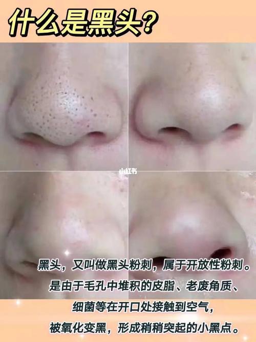 酒糟鼻,草莓鼻不用说,都知道指的是黑头吧