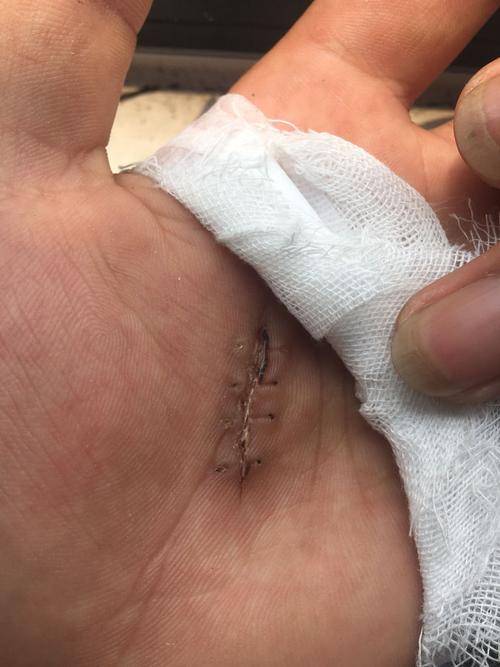 手掌被美工刀割伤缝4针两周拆线后 伤口还是在裂开着 问下这样会不会