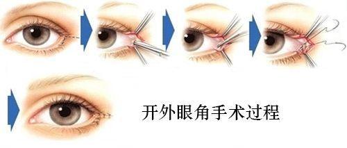 【开外眼角】手术价格_手术特点_开外眼角的原理