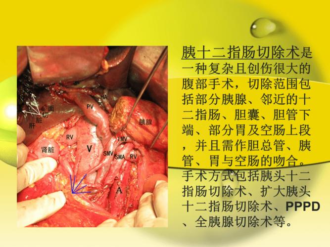 胰十二指肠切除术