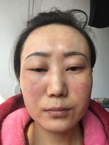皮肤过敏脸和眼睛肿的就像猪头一样,今天已经是第二天