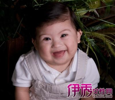 唐氏综合征是一种染色体异常的疾病,又称为先天愚型或21三体综合征,每