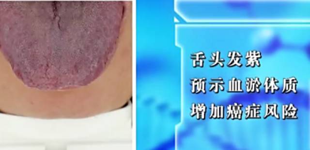 舌头的变化竟然和肿瘤紧密相关?权威专家教您"观舌象,识肿瘤"!